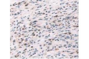 IHC-P analysis of Human Stomach Cancer Tissue, with DAB staining. (TNF alpha antibody  (AA 77-233))