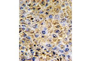 Formalin-fixed and paraffin-embedded human hepatocarcinoma with DCN Antibody (Center), which was peroxidase-conjugated to the secondary antibody, followed by DAB staining. (Decorin antibody  (AA 122-150))