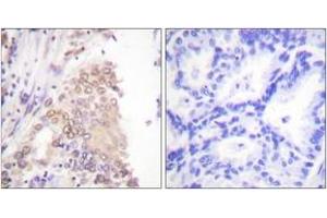 Immunohistochemistry analysis of paraffin-embedded human lung carcinoma tissue, using AML1 (Ab-276) Antibody. (RUNX1 antibody  (AA 242-291))