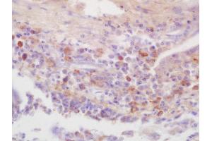Formalin-fixed and paraffin embedded human lung carcinoma labeled with Rabbit Anti-IRAK4(Thr345) Polyclonal Antibody, Unconjugated (ABIN2177052) at 1:200 followed by conjugation to the secondary antibody and DAB staining (IRAK4 antibody  (pThr345))