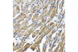 Immunohistochemistry of paraffin-embedded human liver cancer using THUMPD3 Rabbit pAb (ABIN6132951, ABIN6149133, ABIN6149134 and ABIN6214652) at dilution of 1:200 (40x lens). (THUMPD3 antibody  (AA 1-250))