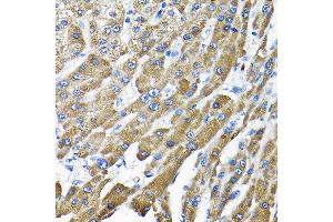Immunohistochemistry of paraffin-embedded human liver cancer using THUMPD3 Rabbit pAb (ABIN6132951, ABIN6149133, ABIN6149134 and ABIN6214652) at dilution of 1:200 (40x lens). (THUMPD3 antibody  (AA 1-250))