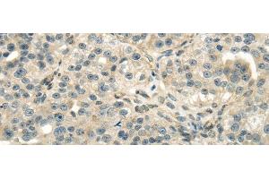 Immunohistochemistry of paraffin-embedded Human breast cancer using DLAT Polyclonal Antibody at dilution of 1/40 (DLAT antibody)