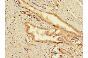 Immunohistochemistry of paraffin-embedded human prostata cancer using ABIN7159849 at dilution of 1:100 (Slc25a1 antibody  (AA 124-162))