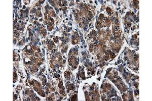 Immunohistochemical staining of paraffin-embedded Carcinoma of liver tissue using anti-SATB1mouse monoclonal antibody. (SATB1 antibody)