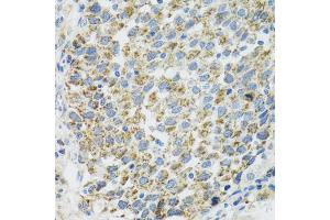 Immunohistochemistry of paraffin-embedded human lung cancer using TXN2 antibody. (TXN2 antibody)