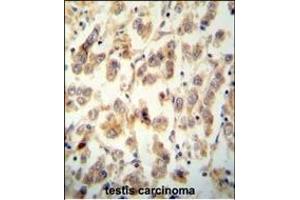 TTC16 antibody (N-term) (ABIN654516 and ABIN2844240) immunohistochemistry analysis in formalin fixed and paraffin embedded human testis carcinoma followed by peroxidase conjugation of the secondary antibody and DAB staining.