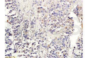 Formalin-fixed and paraffin embedded human colon carcinoma labeled with Anti-TGF-beta-2 Polyclonal Antibody, Unconjugated (ABIN724880) 1:300 followed by conjugation to the secondary antibody and DAB staining (TGF beta 2 Propeptide (AA 154-197) antibody)