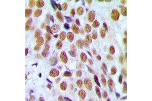 Immunohistochemical analysis of Progesterone Receptor staining in human breast cancer formalin fixed paraffin embedded tissue section. (Progesterone Receptor antibody)