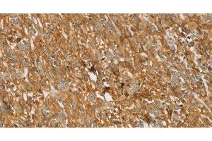 Immunohistochemistry of paraffin-embedded Human gastric cancer using TMPRSS11F Polyclonal Antibody at dilution of 1:30 (TMPRSS11F antibody)