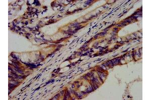 IHC image of ABIN7146245 diluted at 1:600 and staining in paraffin-embedded human colon cancer performed on a Leica BondTM system. (Cadherin 9 antibody  (AA 131-314))