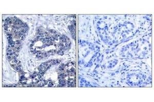 Immunohistochemical analysis of paraffin-embedded human breast carcinoma tissue using IRS-1(Phospho-Ser639) Antibody(left) or the same antibody preincubated with blocking peptide(right). (IRS1 antibody  (pSer639))