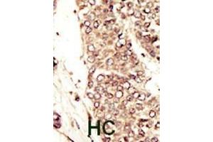 Formalin-fixed and paraffin-embedded human cancer tissue reacted with the primary antibody, which was peroxidase-conjugated to the secondary antibody, followed by AEC staining. (IGF1R antibody  (C-Term))