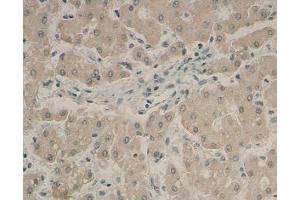 IHC analysis of formalin-fixed paraffin-embedded human liver with protein staining, using AFP antibody (1/100 dilution). (alpha Fetoprotein antibody  (Middle Region))