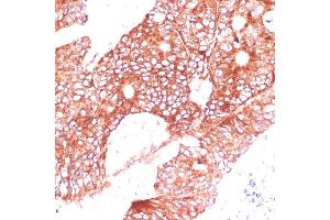 Immunohistochemistry of paraffin-embedded human colon carcinoma using FA antibody (ABIN7267121) at dilution of 1:100 (40x lens). (FAM98A antibody  (AA 1-220))