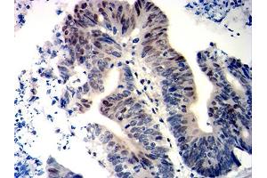 Immunohistochemical analysis of paraffin-embedded colon cancer tissues using WT1 mouse mAb with DAB staining.