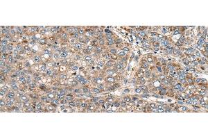 Immunohistochemistry of paraffin-embedded Human liver cancer tissue using CADM2 Polyclonal Antibody at dilution of 1:40(x200) (CADM2 antibody)