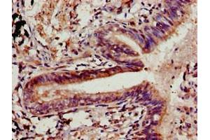Immunohistochemistry of paraffin-embedded human lung cancer using ABIN7147907 at dilution of 1:100 (Claudin 5 antibody  (AA 181-218))