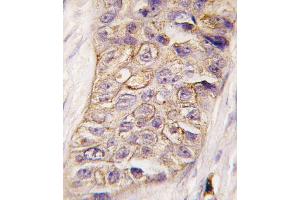 Formalin-fixed and paraffin-embedded human breast carcinoma tissue reacted with PI3KC2B antibody (N-term), which was peroxidase-conjugated to the secondary antibody, followed by DAB staining. (PIK3C2B antibody  (N-Term))