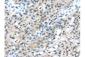 The image on the left is immunohistochemistry of paraffin-embedded Human breast cancer tissue using ABIN7131359(TKT Antibody) at dilution 1/30, on the right is treated with fusion protein. (TKT antibody)