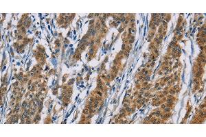 Immunohistochemistry of paraffin-embedded Human gasrtic cancer tissue using ACVR1 Polyclonal Antibody at dilution 1:60 (ACVR1 antibody)