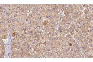 ABIN6277349 at 1/100 staining Human Melanoma tissue by IHC-P. (CTGF antibody  (Internal Region))