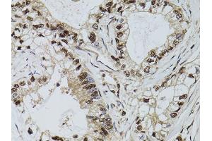 Immunohistochemistry of paraffin-embedded human gastric cancer using DCK antibody (ABIN5970907) at dilution of 1/100 (40x lens). (DCK antibody)