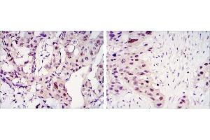 Immunohistochemical analysis of paraffin-embedded mammary cancer tissues (left) and lung cancer tissues (right) using STAT3 antibody with DAB staining. (STAT3 antibody)