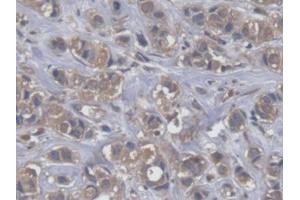 IHC-P analysis of Human Breast cancer Tissue, with DAB staining. (EEF2 antibody  (AA 32-233))