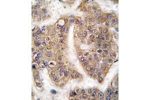 Formalin-fixed and paraffin-embedded human hepatocarcinoma tissue reacted with TRAIP antibody (C-term), which was peroxidase-conjugated to the secondary antibody, followed by DAB staining. (TRAIP antibody  (C-Term))