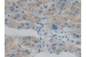 IHC-P analysis of Human Liver Cancer Tissue, with DAB staining. (IFNAR1 antibody  (AA 28-227))