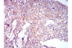 Immunohistochemical analysis of paraffin-embedded breast cancer tissues using COTL1 mouse mAb with DAB staining. (COTL1 antibody)