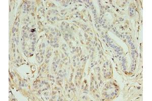 Immunohistochemistry of paraffin-embedded human breast cancer using ABIN7157263 at dilution of 1:100 (KEAP1 antibody  (AA 1-624))