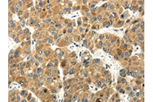 The image on the left is immunohistochemistry of paraffin-embedded Human liver cancer tissue using ABIN7193045(WFDC1 Antibody) at dilution 1/35, on the right is treated with synthetic peptide. (WFDC1 antibody)