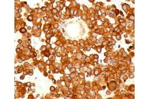 IHC testing of human melanoma stained with CD63 antibody (MX49. (CD63 antibody)