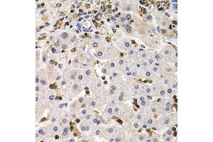 Immunohistochemistry of paraffin-embedded human liver cancer using BCL11A antibody at dilution of 1:200 (400x lens). (BCL11A antibody)