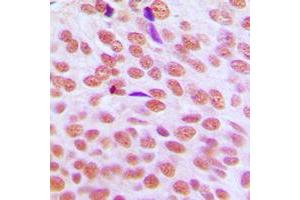 Immunohistochemical analysis of HP1 alpha staining in human breast cancer formalin fixed paraffin embedded tissue section. (CBX5 antibody  (Center))