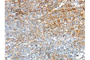 The image on the left is immunohistochemistry of paraffin-embedded Human ovarian cancer tissue using ABIN7192909(TRIM47 Antibody) at dilution 1/30, on the right is treated with synthetic peptide. (TRIM47 antibody)