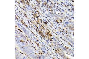 Immunohistochemistry of paraffin-embedded human colon carcinoma using Ferritin Heavy Chain Rabbit mAb (ABIN7267168) at dilution of 1:100 (40x lens). (FTH1 antibody)