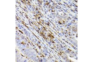 Immunohistochemistry of paraffin-embedded human colon carcinoma using Ferritin Heavy Chain Rabbit mAb (ABIN7267168) at dilution of 1:100 (40x lens). (FTH1 antibody)