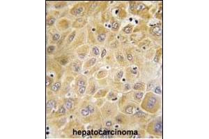 Formalin-fixed and paraffin-embedded human hepatocarcinoma tissue reacted with GRK7 Antibody (C-term) (ABIN392124 and ABIN2841868) , which was peroxidase-conjugated to the secondary antibody, followed by DAB staining. (GRK7 antibody  (C-Term))