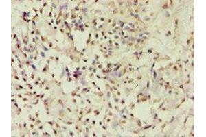 Immunohistochemistry of paraffin-embedded human breast cancer using ABIN7143182 at dilution of 1:100 (ACVR2B antibody  (AA 19-140))