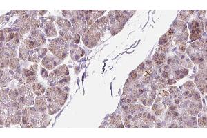 ABIN6273299 at 1/100 staining Human pancreas cancer tissue by IHC-P. (PMM2 antibody  (C-Term))