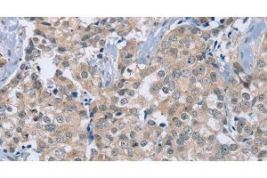 Immunohistochemistry of paraffin-embedded Human breast cancer using RAB8B Polyclonal Antibody at dilution of 1:40 (RAB8B antibody)