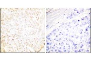 Immunohistochemistry analysis of paraffin-embedded human breast carcinoma tissue, using XRCC5 Antibody. (X-Ray Repair Cross Complementing 5 (AA 683-732) antibody)