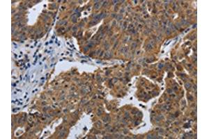 The image on the left is immunohistochemistry of paraffin-embedded Human ovarian cancer tissue using ABIN7192614(SPAG4 Antibody) at dilution 1/50, on the right is treated with synthetic peptide. (SPAG4 antibody)