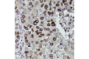 Immunohistochemistry of paraffin-embedded human liver cancer using KDM3A Rabbit pAb (ABIN6134725, ABIN6142790, ABIN6142791 and ABIN6215526) at dilution of 1:150 (40x lens). (KDM3A antibody  (AA 350-450))