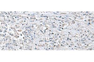 Immunohistochemistry of paraffin-embedded Human liver cancer tissue using EPM2A Polyclonal Antibody at dilution of 1:55(x200) (EPM2A antibody)