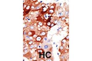 Formalin-fixed and paraffin-embedded human hepatocellular carcinoma tissue reacted with the ACSL4 polyclonal antibody  , which was peroxidase-conjugated to the secondary antibody, followed by DAB staining. (ACSL4 antibody  (AA 244-274))