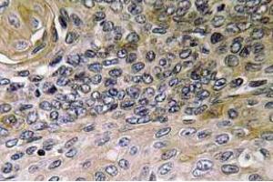 Immunohistochemistry (IHC) analyzes of IL-8 antibody in paraffin-embedded human lung carcinoma tissue. (IL-8 antibody)